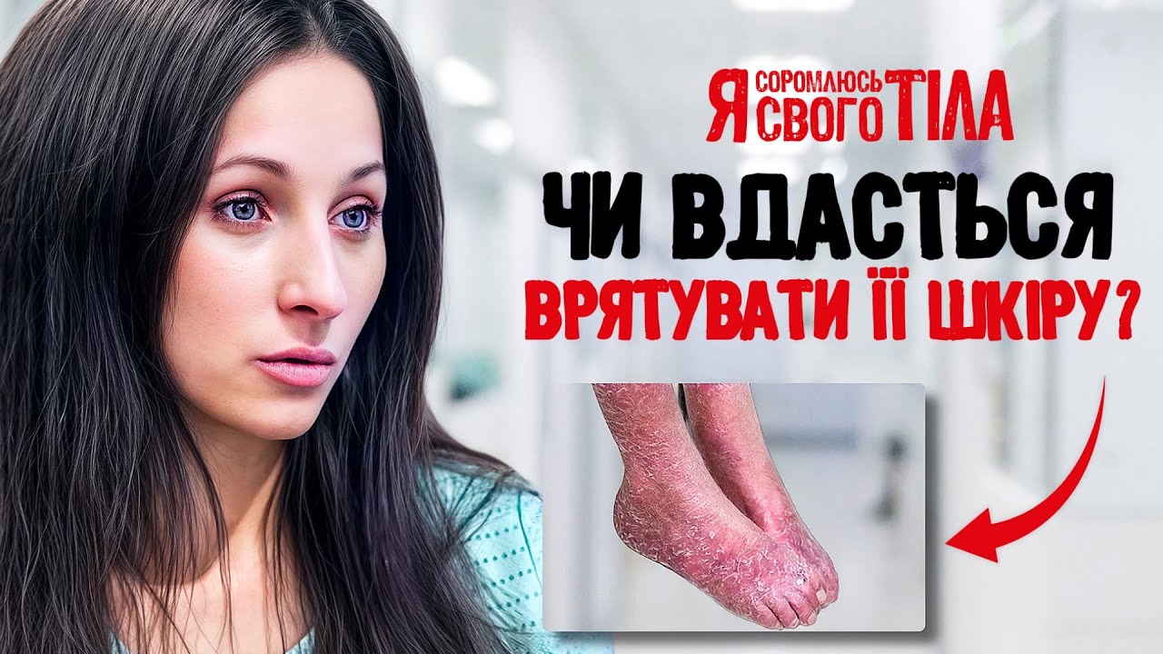 Редкая болезнь, которую никто не может объяснить! – Я соромлюсь свого тіла | БОЛЕЗНИ | МЕДИЦИНА