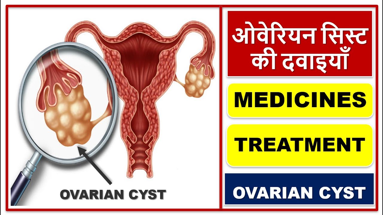 ओवेरियन सिस्ट की दवाइयाँ, OVARIAN CYST, TYPES, SIZE, CAUSES, SYMPTOM, DIAGNOSIS, TREATMENT, MEDICINE