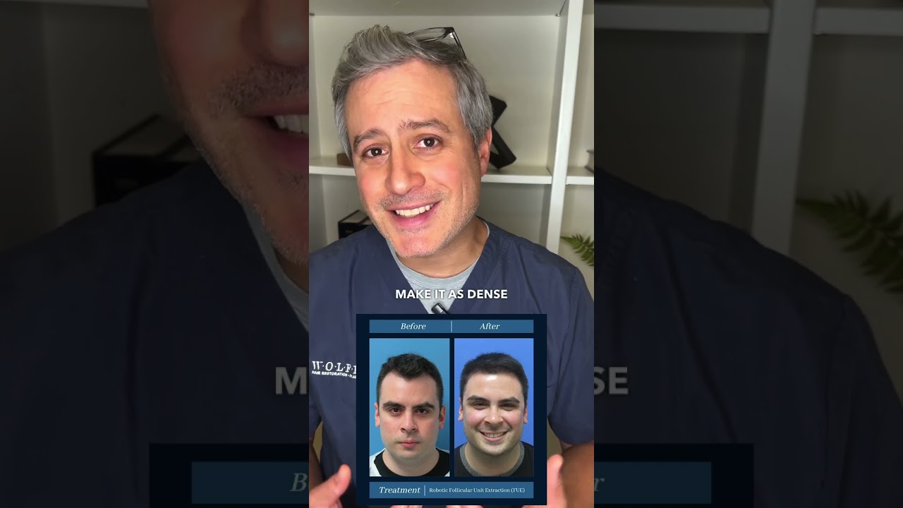 Everything you need to know about your SECOND hair transplant!