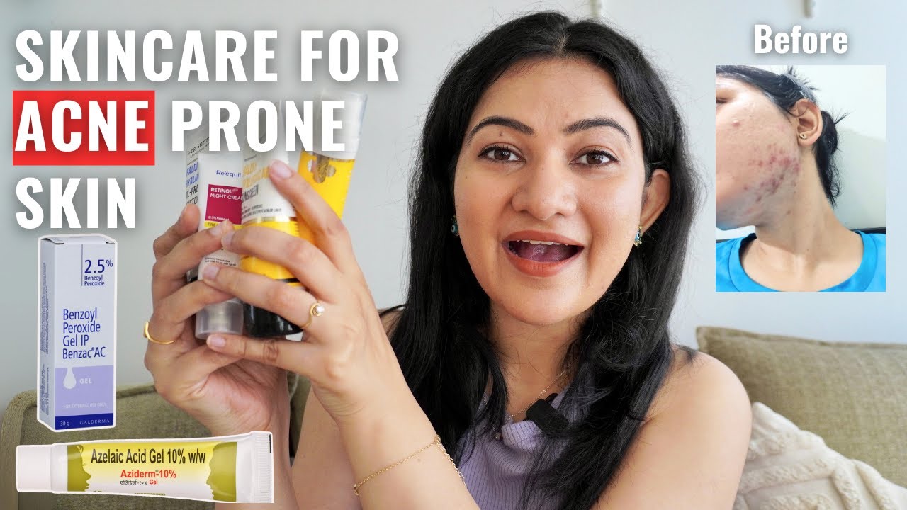 My Skincare Routine (for Acne Prone Skin) | Benzoyl Peroxide, Aziderm, Retinol experience for acne