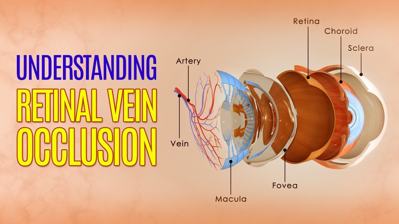 Understanding Retinal Vein Occlusion (RVO)