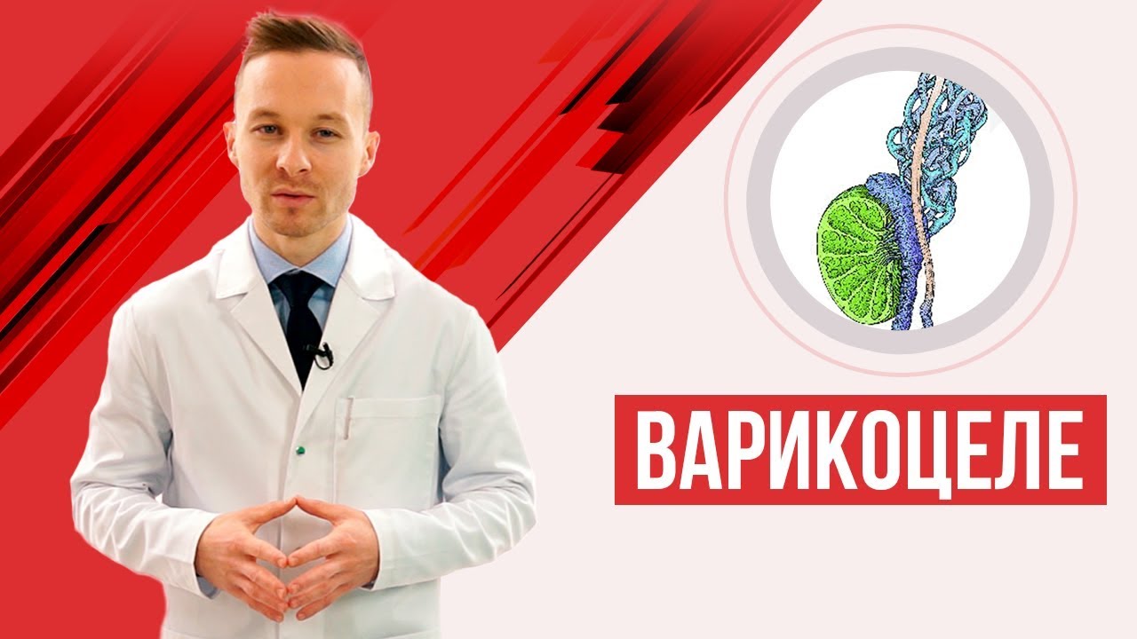 Варикоцеле - подробное видео с 3D ( симптомы, лечение, когда нужна операция?)