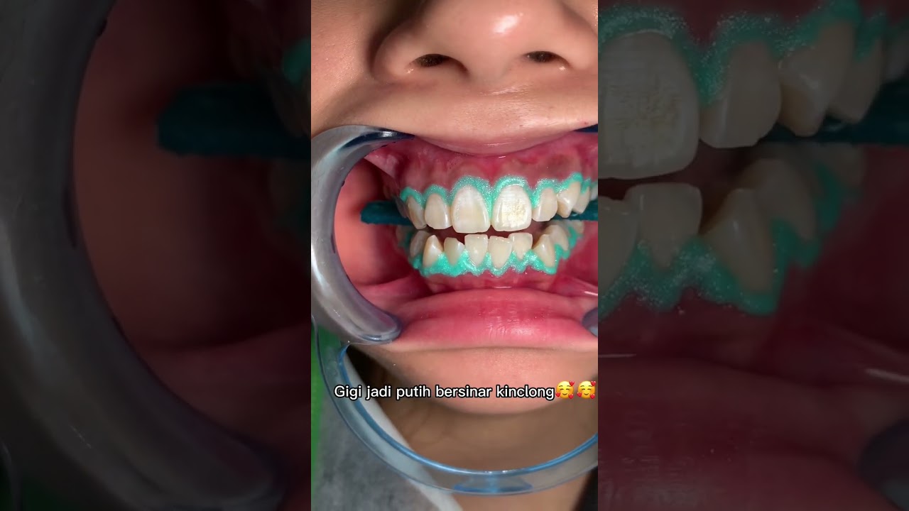 Bleaching Gigi / pemutihan gigi di dokter gigi