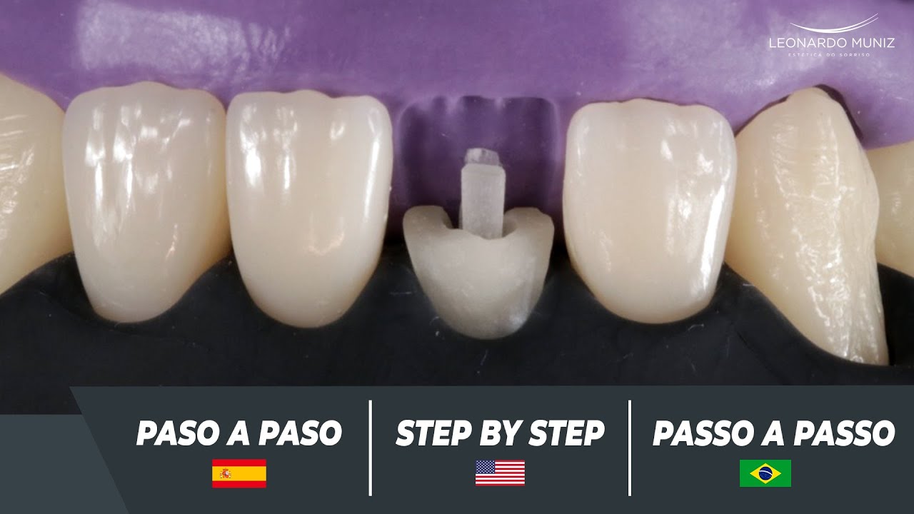 Facetas com Resinas e Pinos em Incisivos Inferiores / Carilla con Resinas y Postes en Incisivo