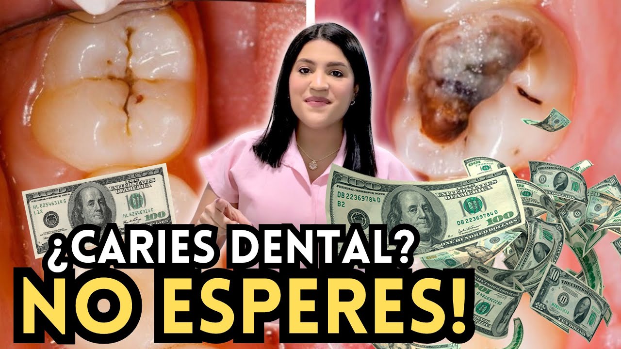 Lo que no sabías de la CARIES DENTAL🚨
