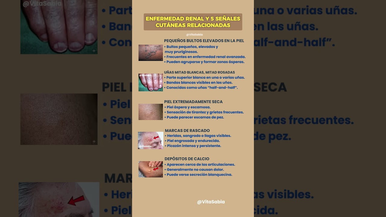 ENFERMEDAD RENAL Y 5 SE&Ntilde;ALES CUT&Aacute;NEAS RELACIONADAS