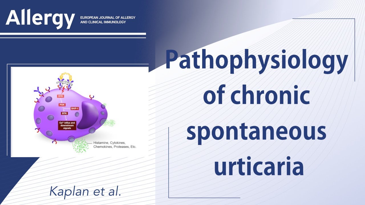 Chronic spontaneous urticaria: focus on pathophysiology to unlock treatment advances