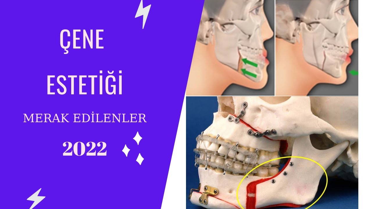 Çene Estetiği Ameliyatı Nedir II 2022