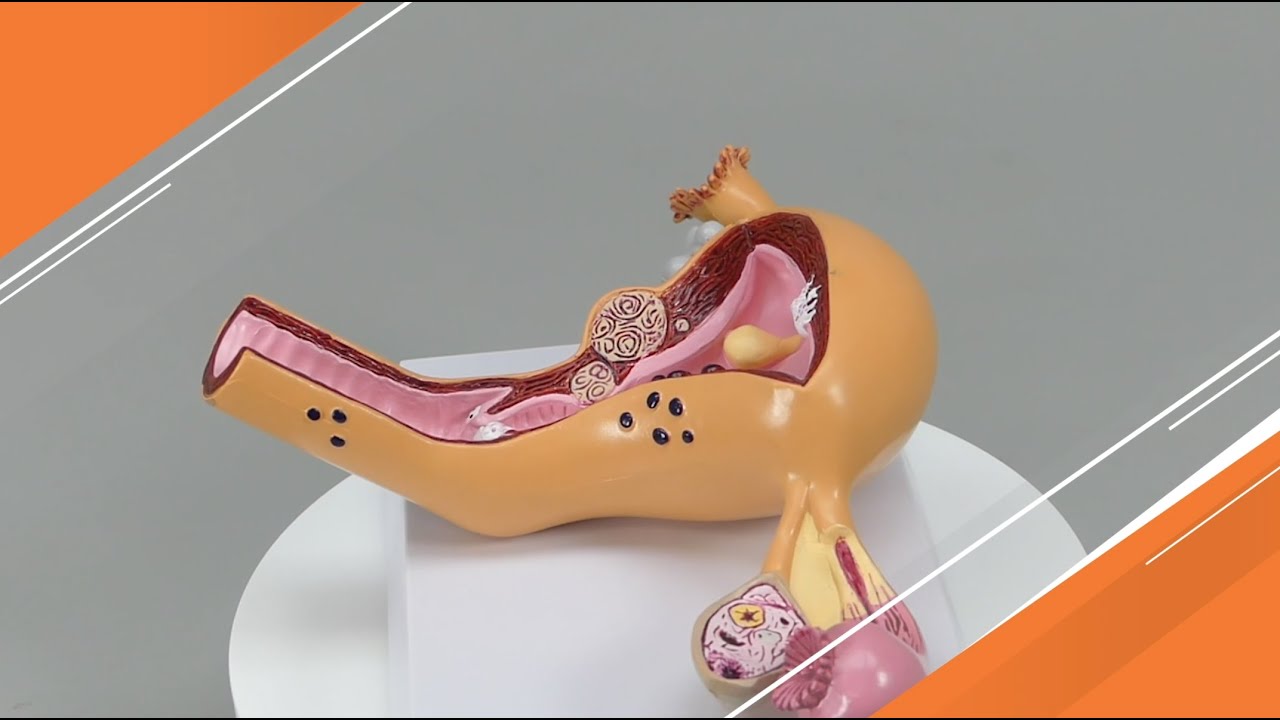 Diseased Uterus and Ovaries Model | AnatomyStuff
