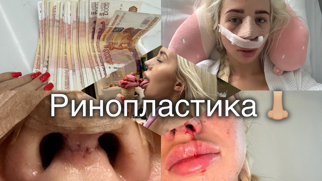 РИНОПЛАСТИКА в 2023 году 👃🏼