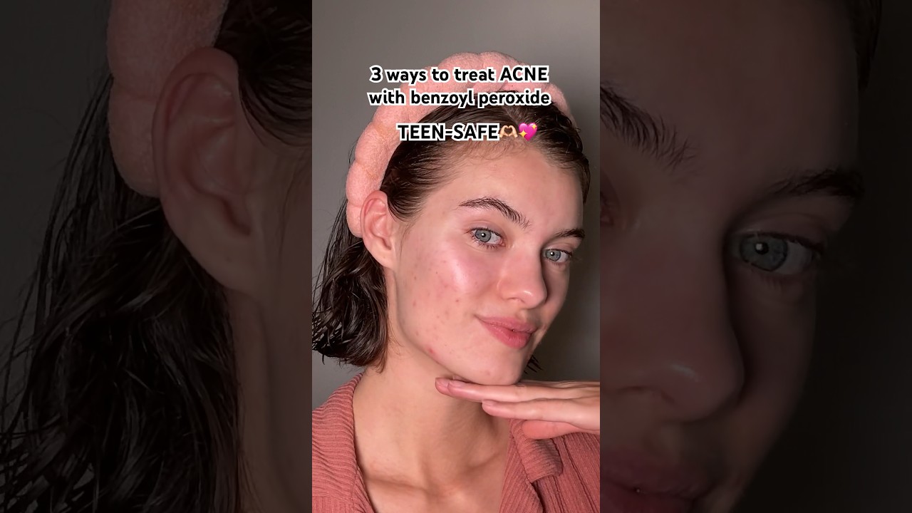 Acne treatment (TEEN-SAFE) 🫶🏻💖 have you tried benzoyl peroxide? #acnetreatment #acne #skincare