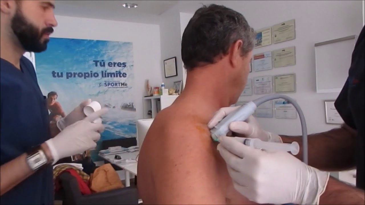 Puncion-Aspiracion de Tendinitis calcificante en el Subescapular. Tecnica de Barbotaje