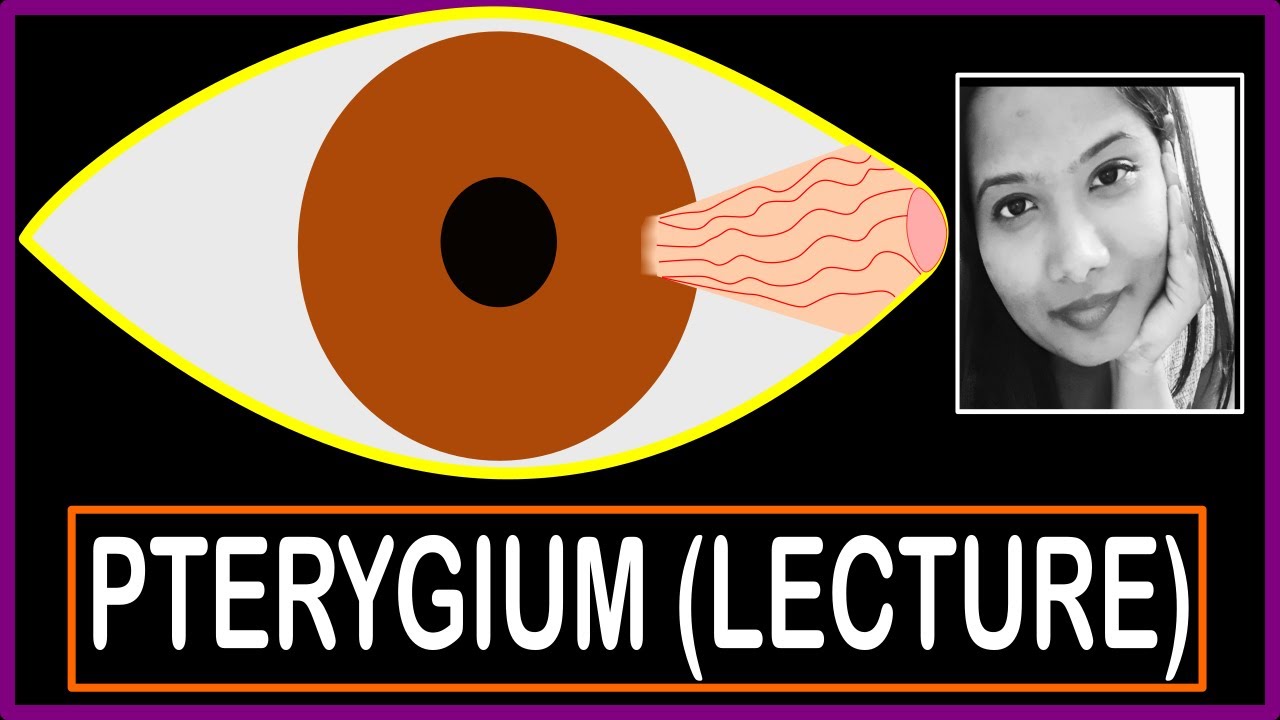 Pterygium (Lecture) - Structure, Histopathology, Excision, Prevention, Pseudopterygium, Pinguecula