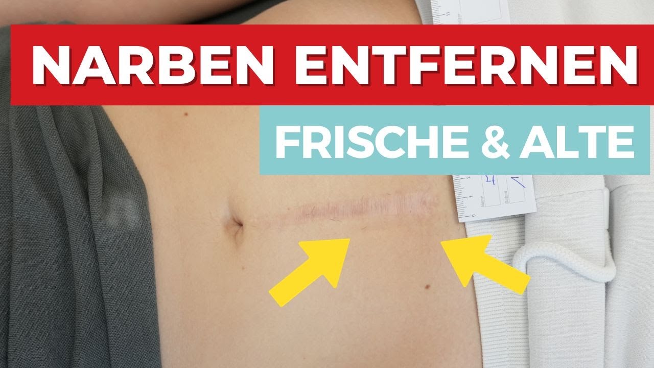 Narben entfernen - So kannst du es selber bei frischen & alten Narben