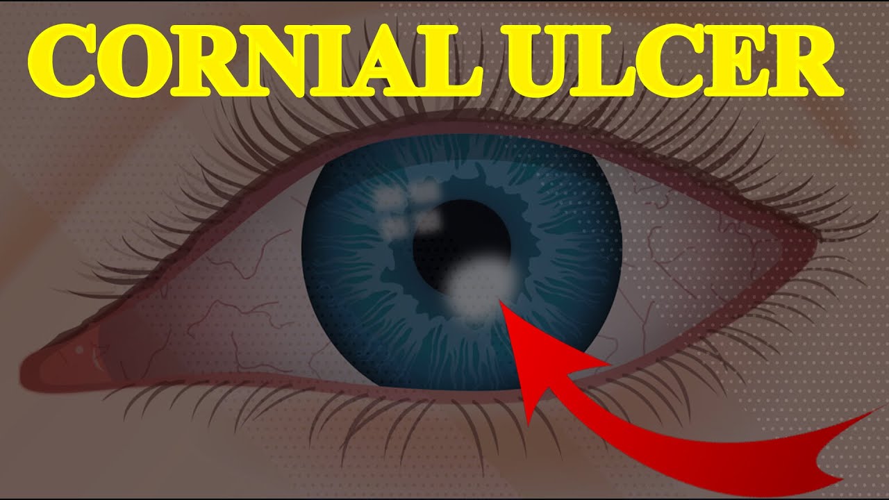 Corneal Ulcer। আঘাতজনিত কারণে কর্নিয়া ক্ষতিগ্রস্থ হলে করনীয়। Doctors Tv BD