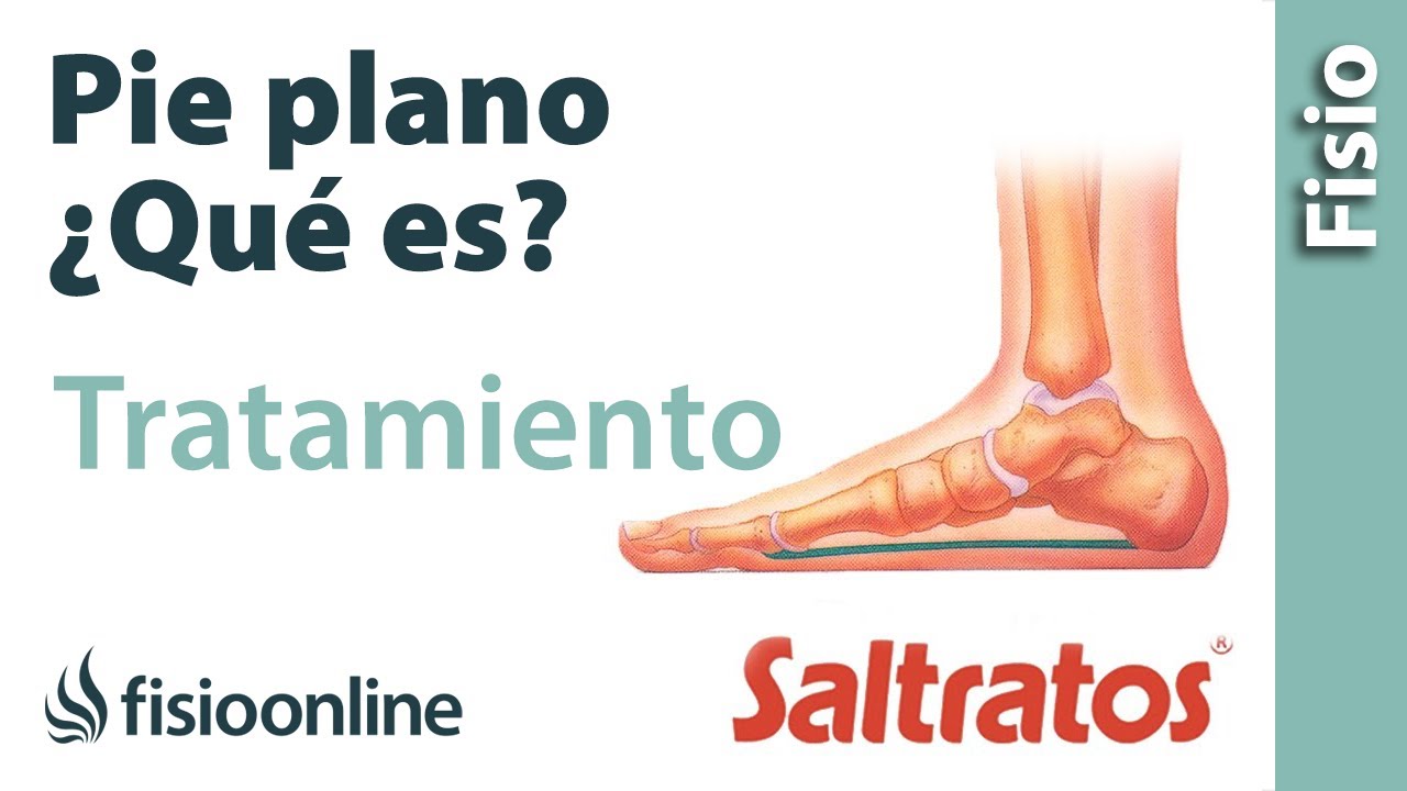 Pie plano o ca&iacute;do - Qu&eacute; es, causas, s&iacute;ntomas y tratamiento