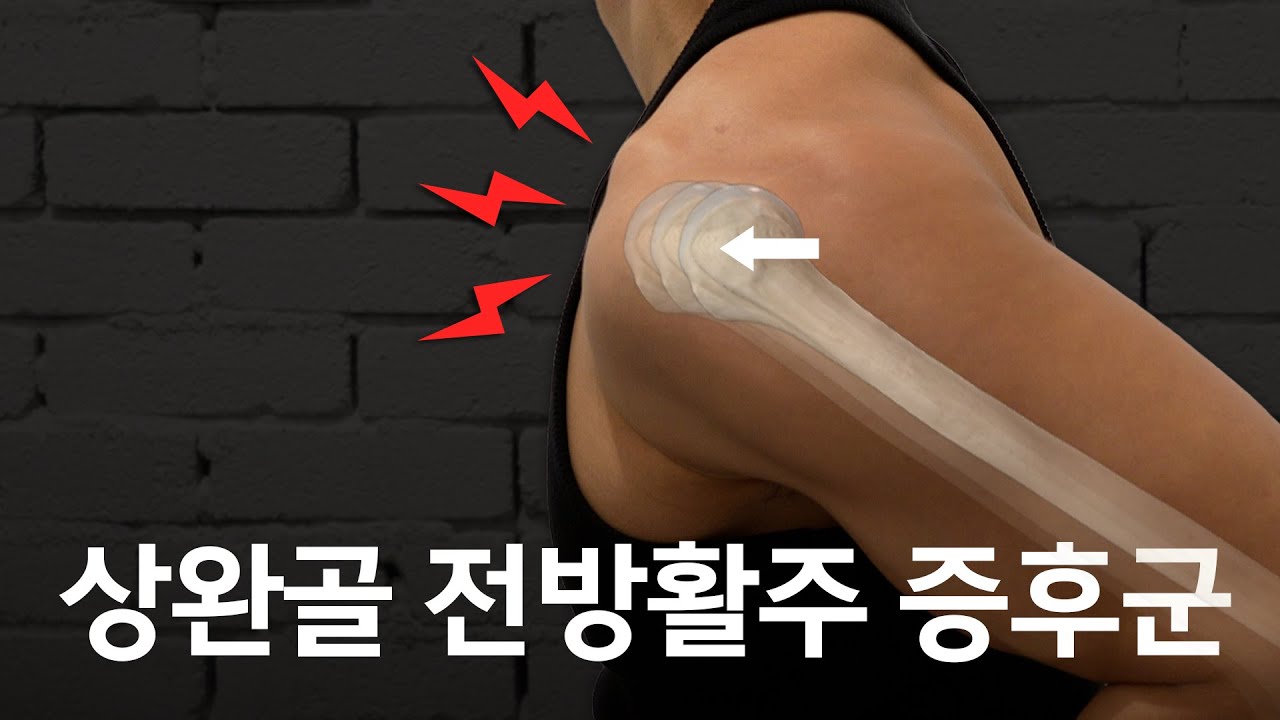 상완골 전방활주에 관한 모든 것 : 원인, 검사, 교정방법 - 어깨 재활에 평생 사용하게 될 지식 모음