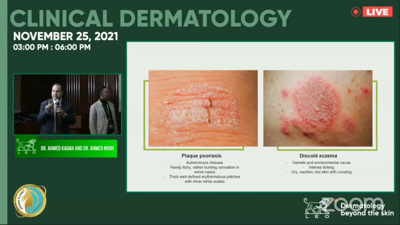 psoriasis by Dr Ahmed Nouh & Dr Ahmed kadah