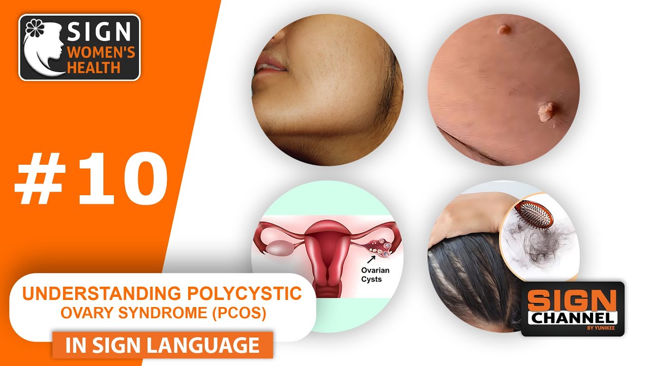 Understanding Polycystic Ovary Syndrome (PCOS)