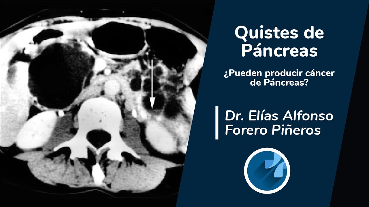 Quistes de páncreas: ¿Pueden producir cáncer de páncreas?