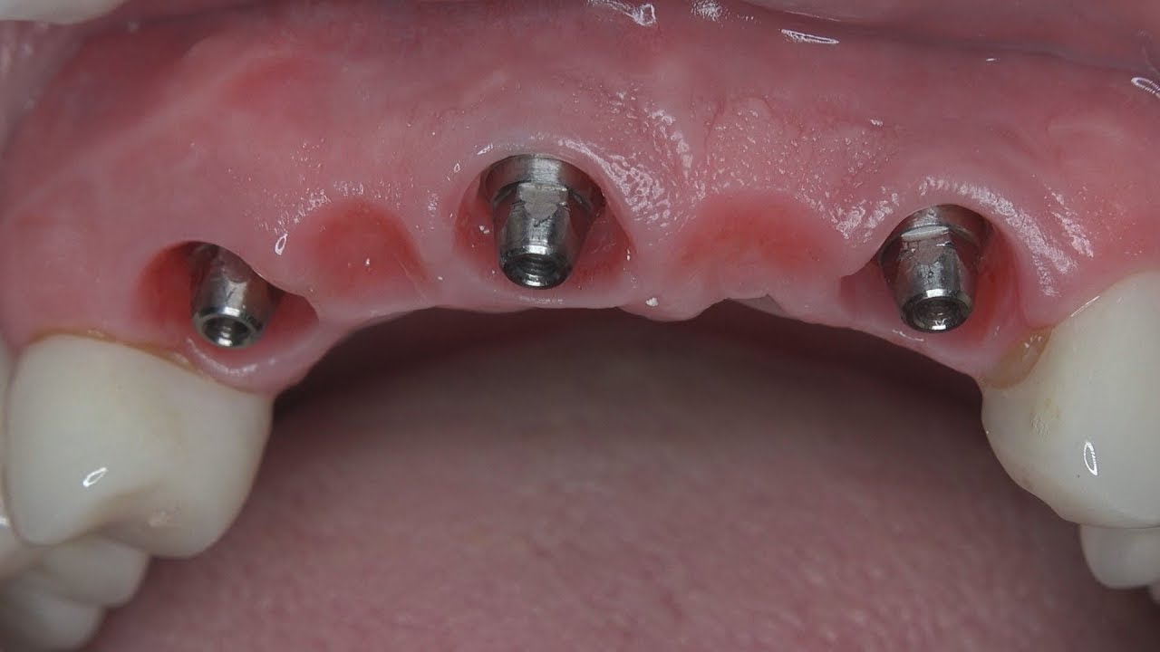 Short implants: Prosthetic planning tips