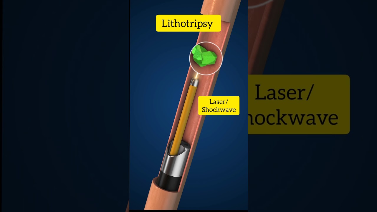 lithotripsy Procedure | stone removal from kidney