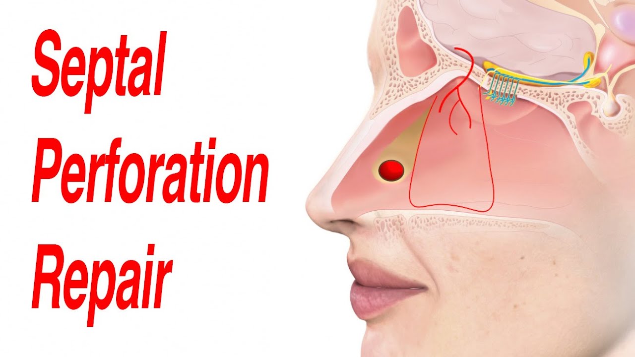 Septal Perforation Repair