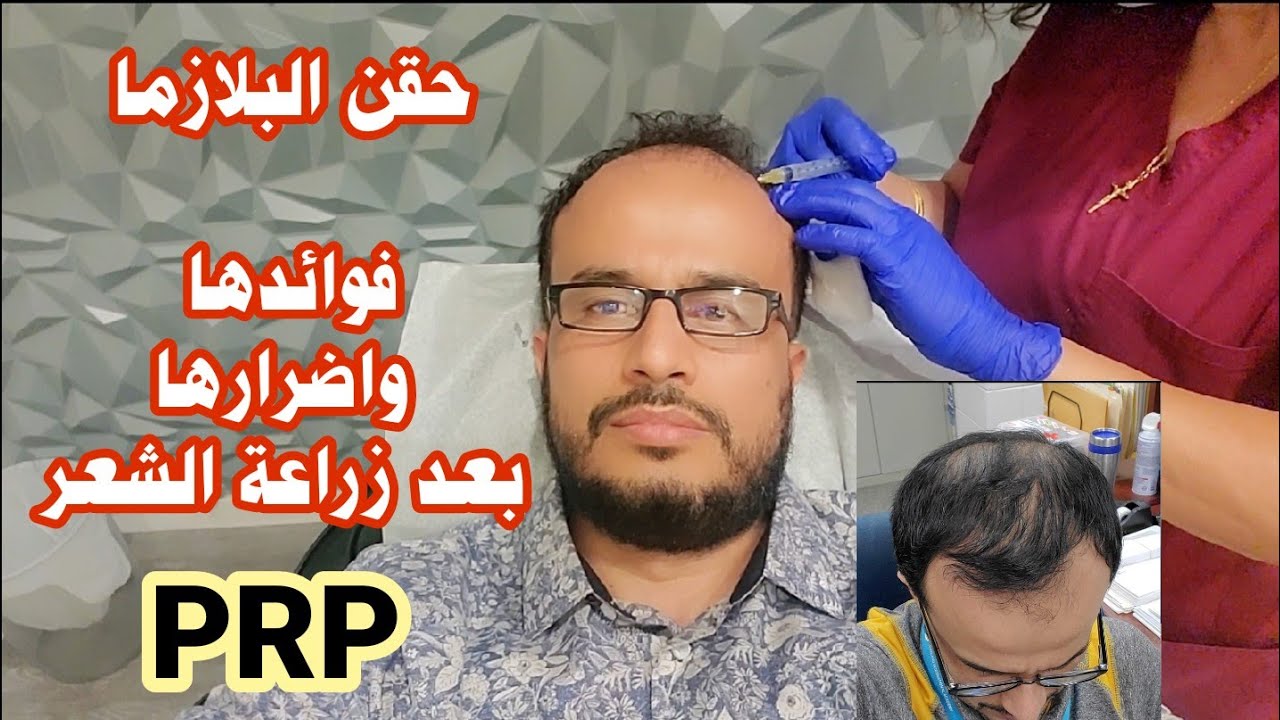 حقن البلازما وفوائدها على زراعة الشعر مع عقيل الحالمي