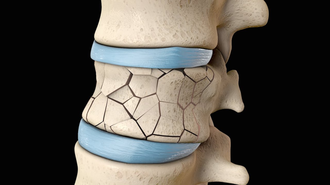 Back Surgery | Vertebroplasty and Kyphoplasty | Nucleus Health