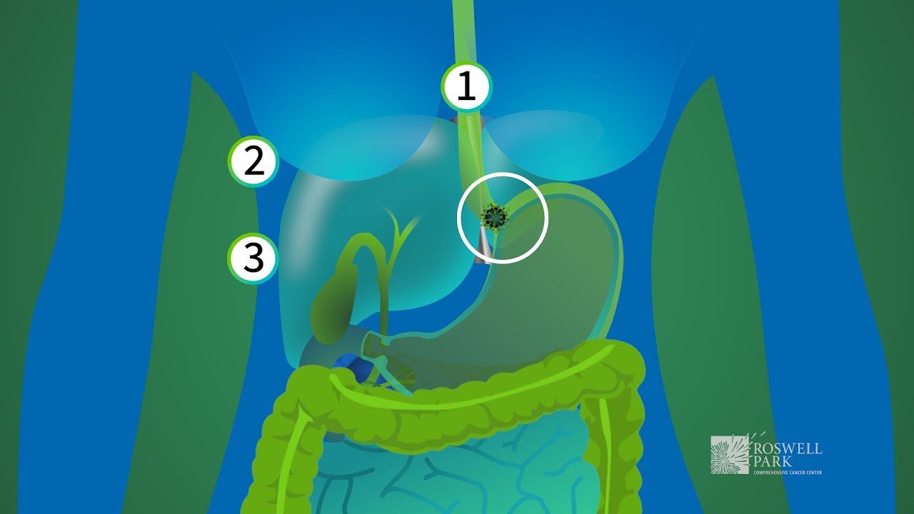 Robotic Surgery for Esophageal Cancer