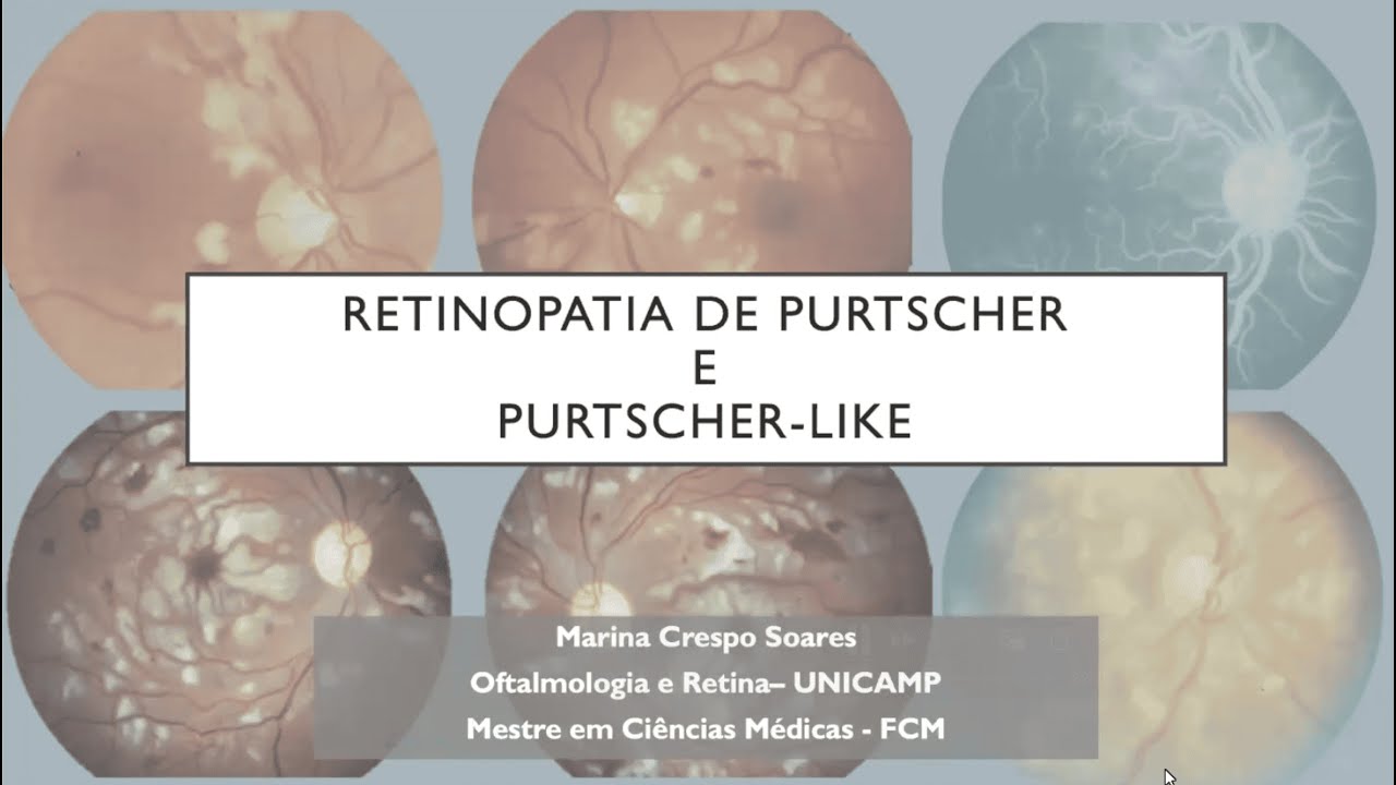 Retina e Vítreo (17/07/2025) - Retinopatia de Purtscher e Purtscher-like