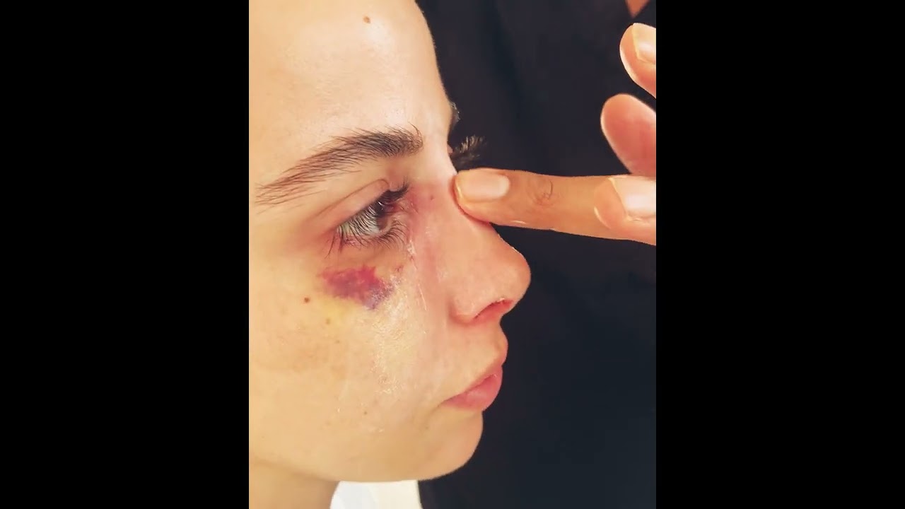 Le massage en rhinoplastie après ablation du plâtre