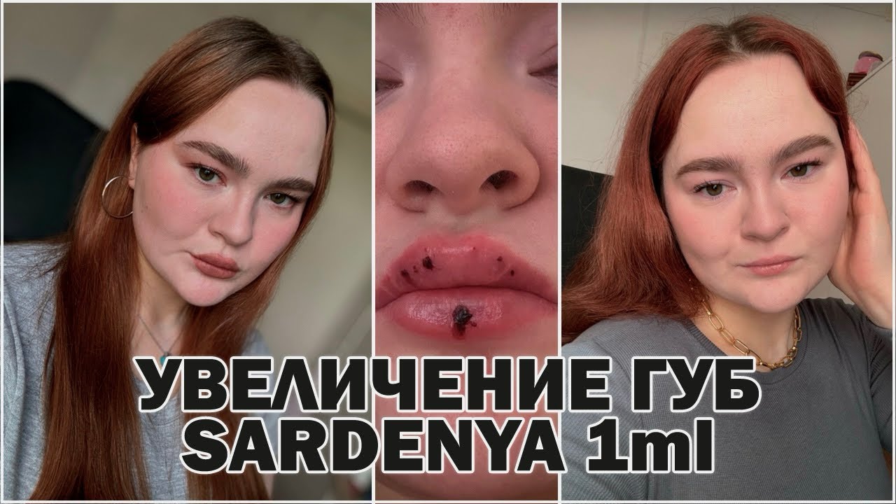 УВЕЛИЧЕНИЕ ГУБ | ВСЯ ПРАВДА | ДО И ПОСЛЕ | ПОСЛЕДСТВИЯ, ЗАЖИВЛЕНИЕ