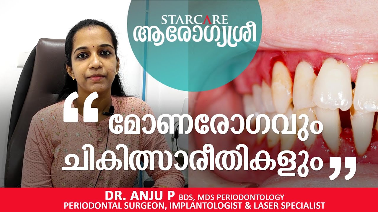 മോണരോഗവും ചികിത്സാരീതികളും | Gum Disease & Treatment | Dr. Anju P | La Dent Studio | Arogyasree
