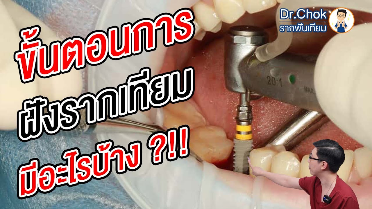 ขั้นตอนการทำรากฟันเทียมมีอะไรบ้าง ?!! | คลายปัญหารากเทียมกับหมอโชค