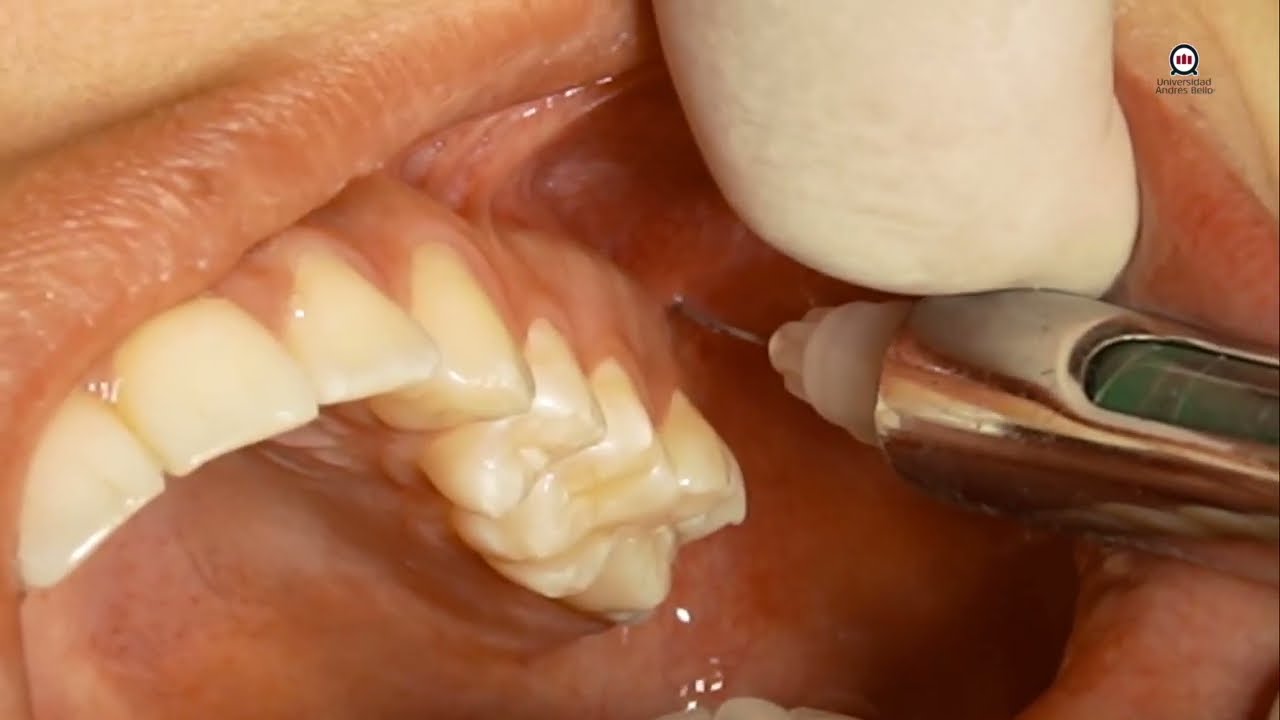 Técnica de la Tuberosidad o para el Nervio Alveolar Superior Posterior