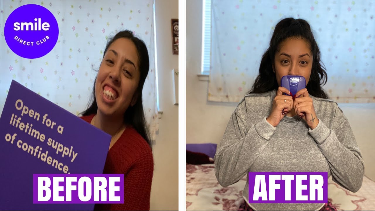 Smile Direct Club Review - Is it worth it? | VanessaMarie