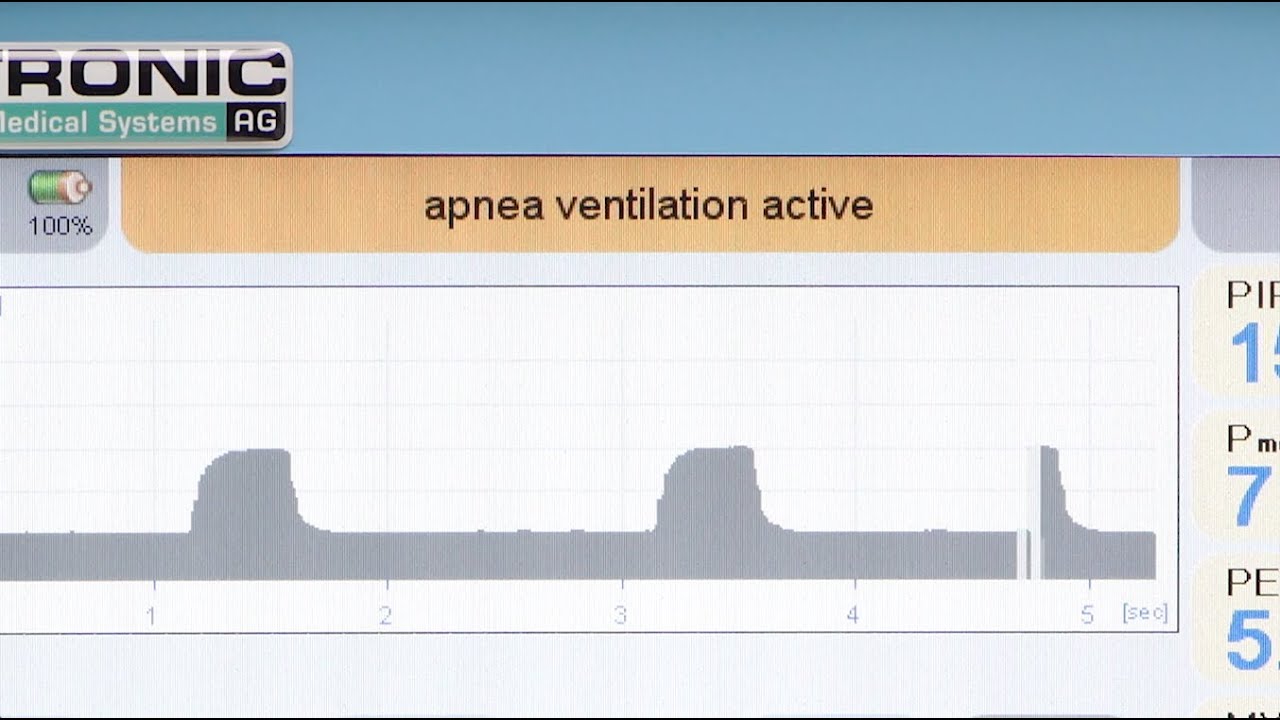 fabian HFO: PSV Pressure Support Ventilation and Apnea Ventilation