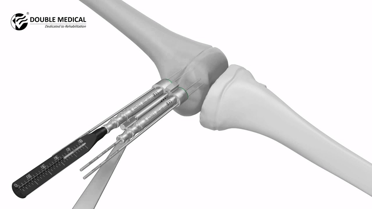 Video Operation of Pediatric Epiphyseal Plate