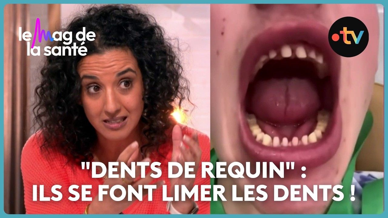 Facettes dentaires : une technique esthétique sans risque pour les dents ?