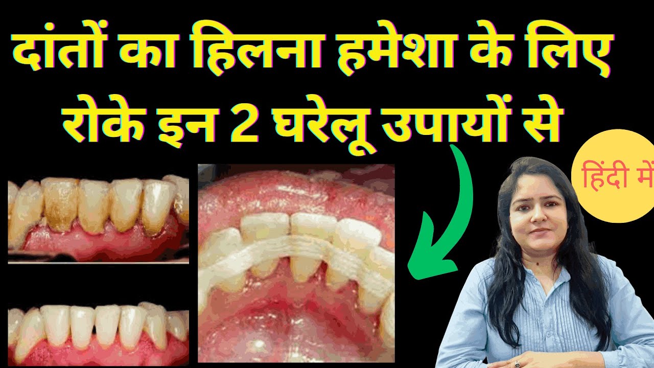  दांतों का हिलना घर पर ही ठीक कैसे करे। hilte danto ko gar par theek kaise kare?? 