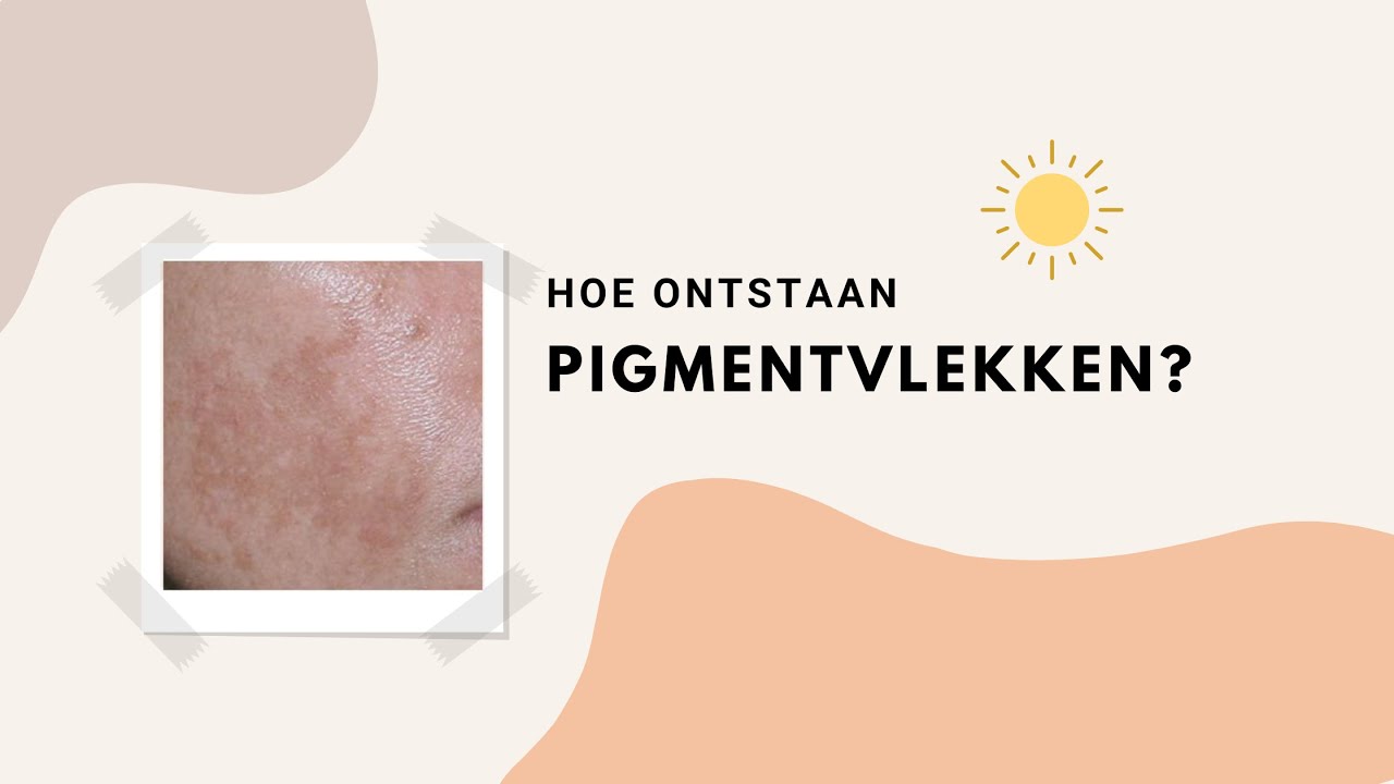 Hoe ontstaan pigmentvlekken?