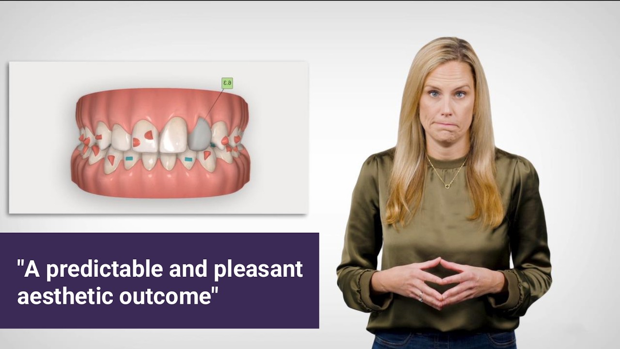 How to use iTero™, Invisalign and exocad™ to plan combined orthodontic and restorative treatments