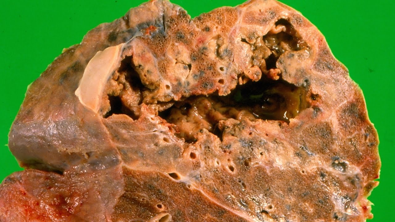 Tuberculosis - Pathology mini tutorial