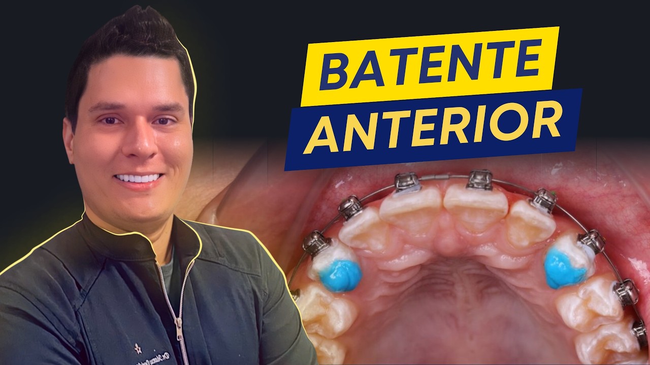 Batente Anterior em Ortodontia: indicações e como funciona!