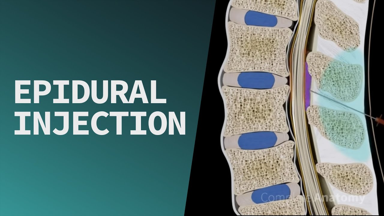 Эпидуральная инъекция