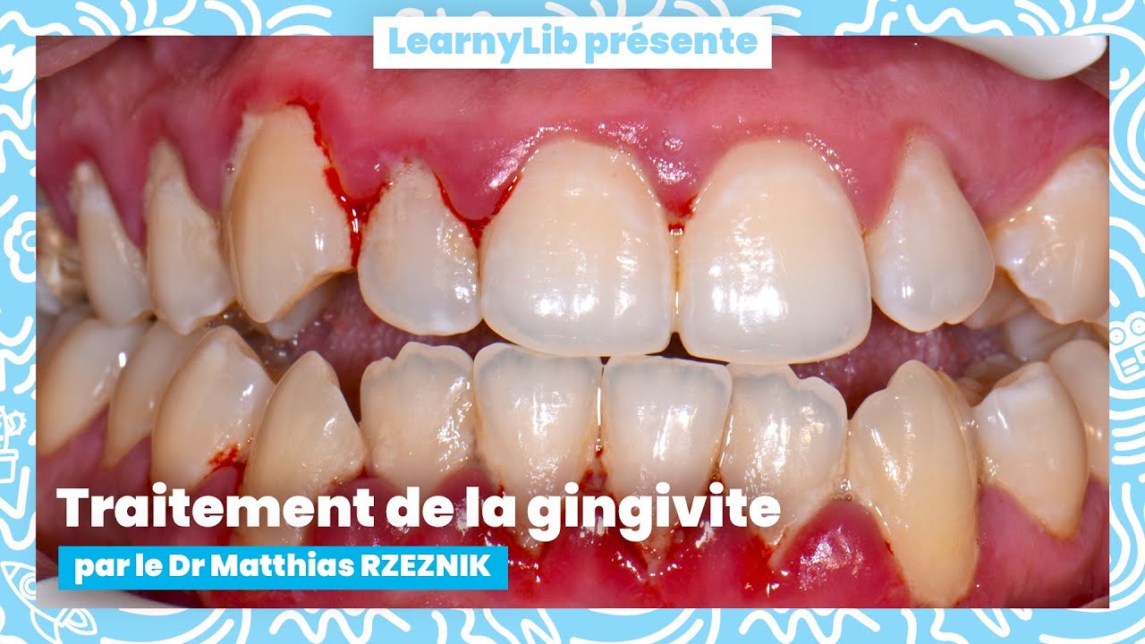 🦷 La parodontie : traitement de la gingivite avec le Dr Matthias RZEZNIK