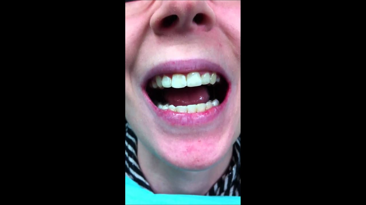 Before & After Adult High Speed Braces(tm)