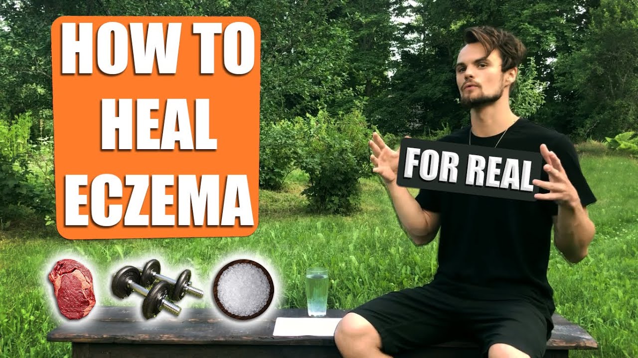 How I healed my ECZEMA naturally / with FOOD, MOVEMENT & HABITS (Rob Stuart)