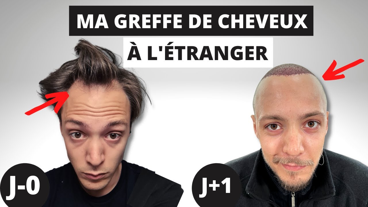 Les 7 Premiers jours de ma Greffe à l'étranger ✈️
